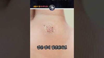 사마귀가 있으시다면..?